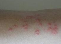  皮肤过敏容易出现哪些危害