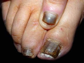  灰指甲的前期症状